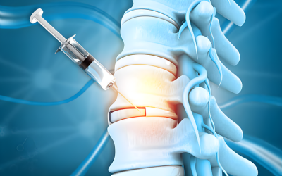 Minimally Invasive Spine Procedures - Mindspine