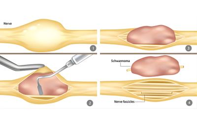 Nerve and Peripheral Surgery - Mindspine